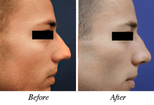 nose correction before after