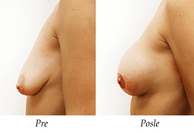 Podizanje i uvećanje grudi - pacijent 18