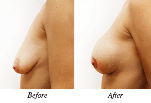 Breast lift&augmentation - Patient 18