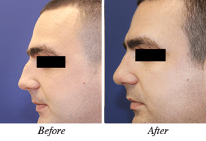 rhinoplasty -before-after