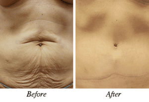 tummytuck - patient 3