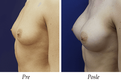 pre i nakon uvećanja grudi - pacijent 13