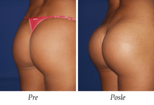 Galerija Pre i Posle - Uvećanje zadnjice