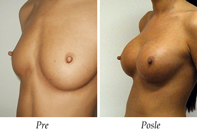 Pre i nakon uvećanja grudi - pacijent 06