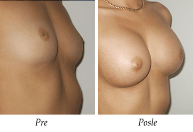 Pre i nakon uvećanja grudi - pacijent 07