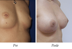 Breast Enlargement Breast Enlargement