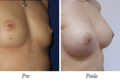 Pre i nakon uvećanja grudi - pacijent 08