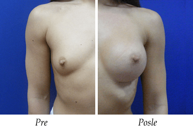 Pre i nakon uvećanja grudi - pacijent 05