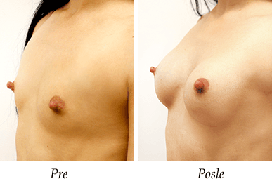 Uvećanje grudi - Pacijent 19