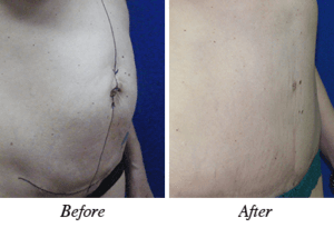 mommy makeover before after