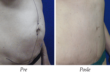 mommy makeover pre posle