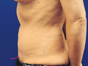 Abdominoplastika - pacijent 3