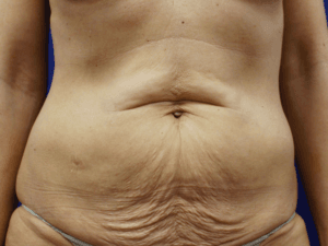 Abdominoplastika - pacijent 3