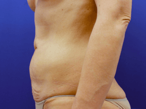 Abdominoplastika - pacijent 3