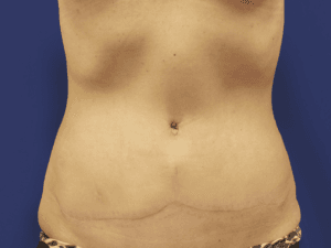 Abdominoplstika - pacijent 3