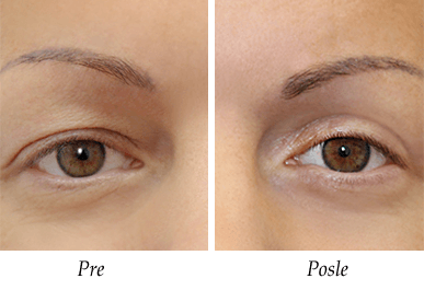 Pacijent 3 - Pre i posle operacije