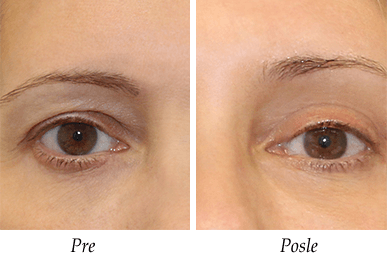 Pacijent 4 - Pre i posle operacije kapaka