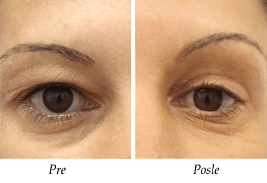 Pacijent 6 - Pre i nakon korekcija kapaka