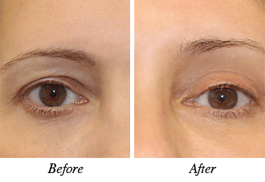 Patient 4 - Before and after intervention