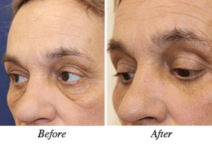 Blepharoplasty Blepharoplasty