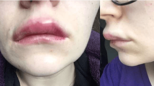 Usta uvećanje - posledice