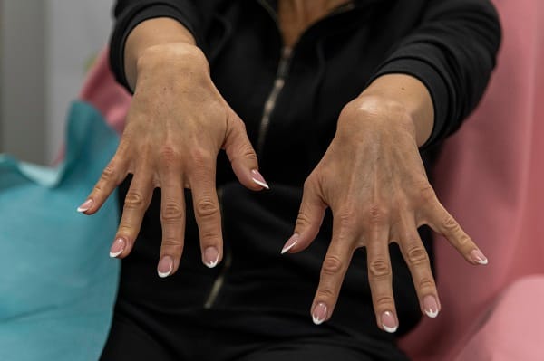 Belotero fileri - šake