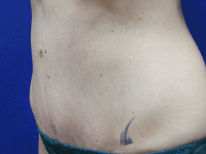 Abdominoplastika posle -- pacijent 4