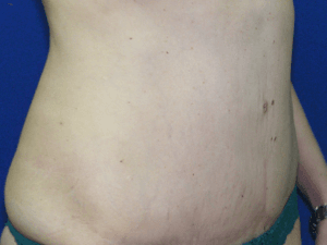 mommy makeover after