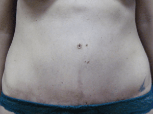 Abdominoplastika posle - pacijent 4