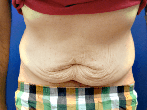 Abdominoplastika pre i posle