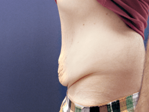 Abdominoplastika pre i posle