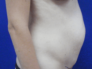 Mommy makeover before