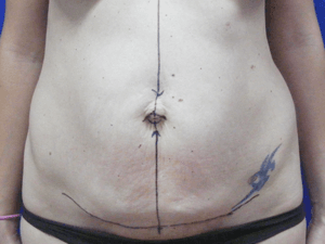 Abdominoplastika pre - pacijent 4
