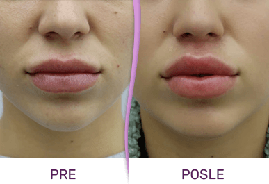 bullhorn lift isecanje kože ispod nosa