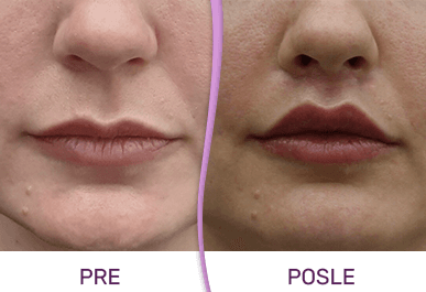 Operacija bullhorn lip lift