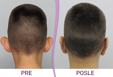 Galerija Pre i Posle - Korekcija ušiju